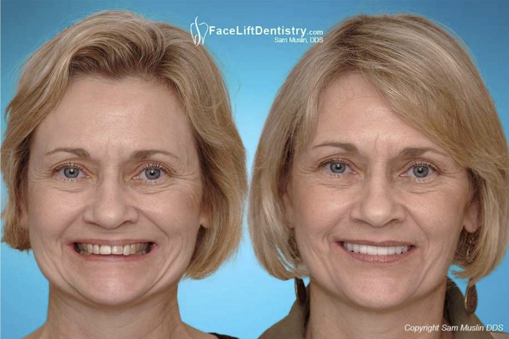 How Your Jaw Alignment Affects Facial Aging - Face Lift Dentistry Sam Muslin DDS