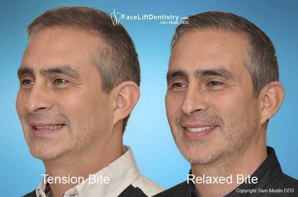 Anti Aging ￼Jaw Correction - Face Lift Dentistry Sam Muslin DDS